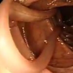 【閲覧注意】大腸の中を這いずり回る “寄生虫” の除去映像。