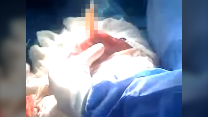 【閲覧注意】3歳児の腸内から “大量の寄生虫” を摘出するグロ動画。