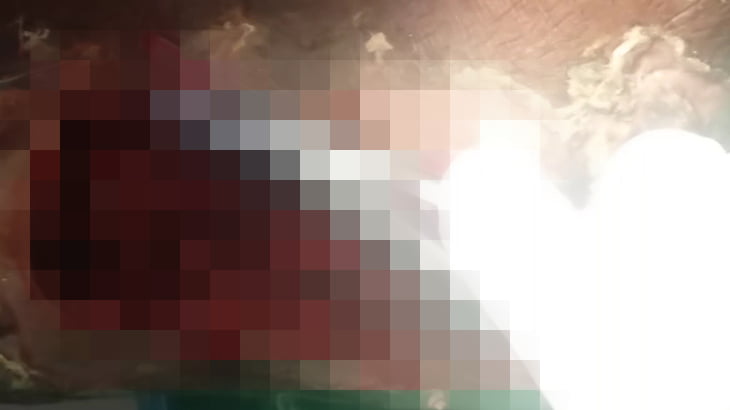 【閲覧注意】糖尿病患者の足、ウジが巣食いもはや切断不可避なグロ動画。
