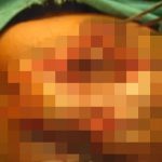 【閲覧注意】陰茎癌になってしまった男性、アソコが蛆虫だらけのグロ動画。