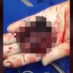 【超！閲覧注意】中絶された胎児、看護婦の手のひらでまだ動いているグロ動画。