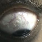 【閲覧注意】ナイジェリア旅行後の女性、目に寄生虫が住み着いてしまったグロ動画。