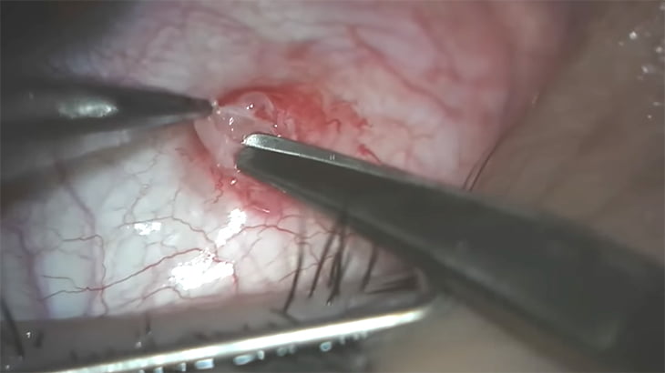 【閲覧注意】目に寄生したワームを摘出するグロ動画。