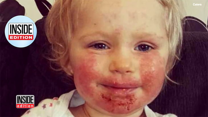 小さな女の子、キスからヘルペスに感染してしまった動画。