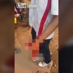 【超！閲覧注意】花火で左手が無くなってしまった男のグロ動画。