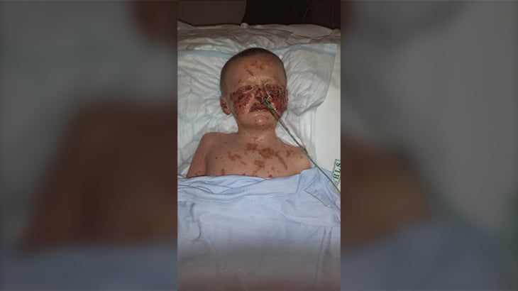 皮膚や粘膜が過敏になる難病「スティーブンス・ジョンソン症候群」。