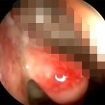 【閲覧注意】鼻の中に住み着いたウジ虫を摘出するグロ動画。