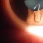 【閲覧注意】角膜の中で悠々と泳ぎまくるワームを撮影したグロ動画。