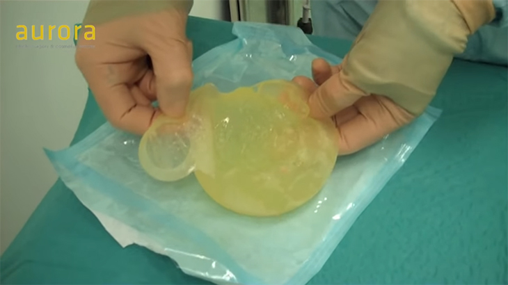 【閲覧注意】破裂した胸のシリコンを新品に差し替える手術動画。