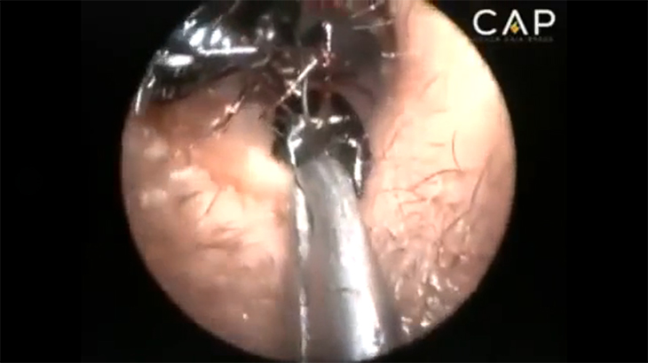 【衝撃映像】12歳の少女、耳の中がアリの巣になってしまった動画。