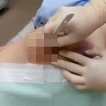 【閲覧注意】なんだかお尻が痛い･･･病院に行ったらとんでもないことに。