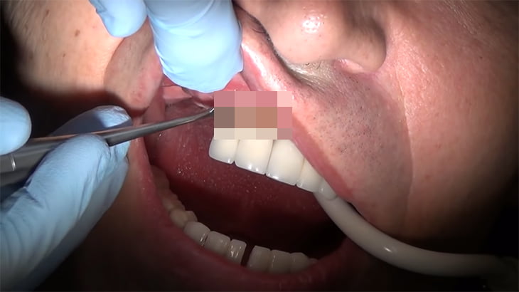 【閲覧注意】歯周病で前歯をごっそり抜くことになってしまったグロ動画。