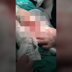 肛門に入れた異物が取れなくなった男の摘出動画。