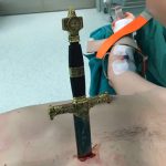 【閲覧注意】自殺のために胸に刺したナイフ、奇跡的に心臓を回避。