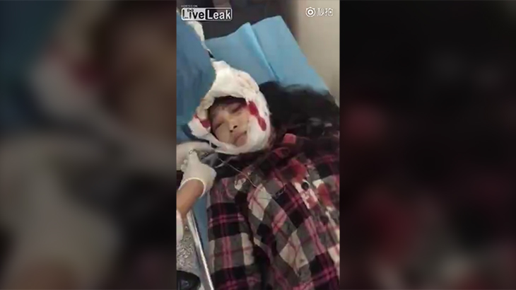 【閲覧注意】事故に遭った女性、頭皮がペロンと剥がれてしまったグロ動画。