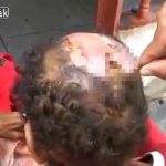 【閲覧注意】生きたまま脳みそをウジ虫に食べられている男のグロ動画。