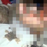 【閲覧注意】糖尿病患者の足、とんでもない量のウジが蠢くグロ動画。