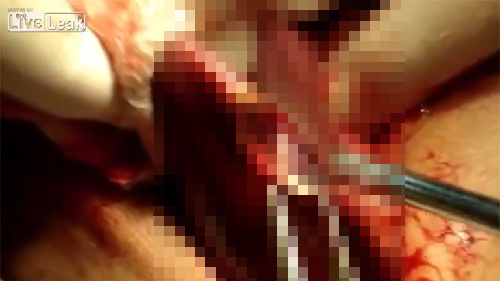 【閲覧注意】人の肝臓にこんな生物がいたら怖すぎる。