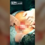 【閲覧注意】帝王切開による出産映像。三つ子の場合。