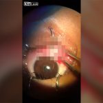 【閲覧注意】目に鉛筆が刺さってしまったので抜いてもらうグロ動画。