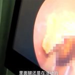 【閲覧注意】こんな大きな “生き物” が耳の中にいるとは･･･。