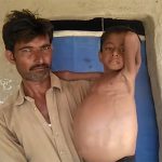 異常にお腹が膨れてしまった少年「ヒルシュスプルング病」の動画。