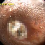 【閲覧注意】耳掃除をしたことのない男。とんでもないことに･･･。