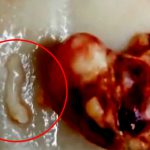 【閲覧注意】人間の頭に “4年間も棲み着いていた” 寄生虫を摘出するグロ動画。