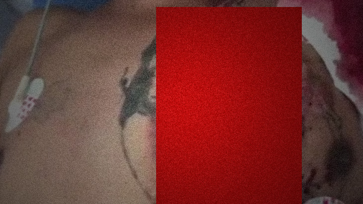 【超！閲覧注意】散弾銃で胸を撃たれ “ヤバイ状態” に･･･。