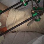 【閲覧注意】足を “骨折してから完治するまで” をまとめたグロ動画。