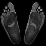 【閲覧注意】「スナノミ」とかいう足の裏に寄生する悪魔。