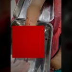 【閲覧注意】踵（かかと）剥がれちゃったグロ動画･･･。