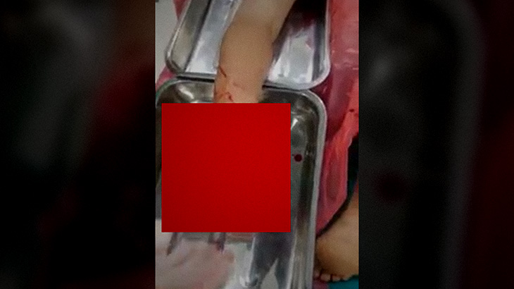 【閲覧注意】踵（かかと）剥がれちゃったグロ動画･･･。