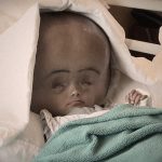 【衝撃映像】頭が通常の3倍にまで “腫れてしまった” 3歳の女の子。