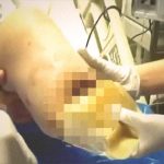 【閲覧注意】この男性の “切断された左足” 、ヤバイことになってたグロ動画･･･。