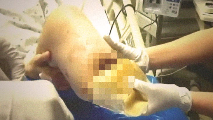 【閲覧注意】この男性の “切断された左足” 、ヤバイことになってたグロ動画･･･。