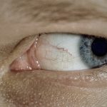 【衝撃映像】目に寄生するワームを “自分で引っこ抜く” 男性･･･。