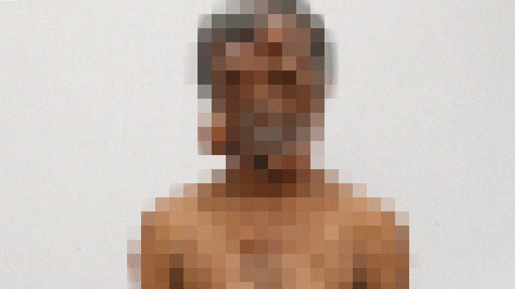 【衝撃映像】全身 “コブだらけ” の奇病に侵されてしまった男性。