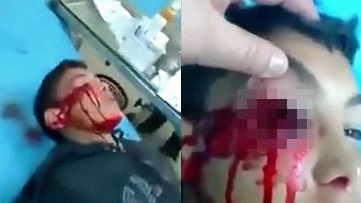 【閲覧注意】銃で顔を撃たれた男の子、右目を失ってしまったグロ動画。