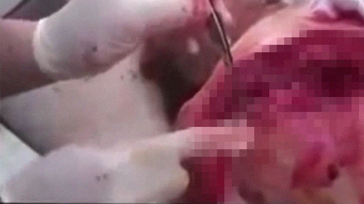 【閲覧注意】背中がパックリ割れてしまった男性を麻酔なしで縫合するグロ動画。