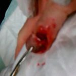【閲覧注意】負傷した爪の手術を見て失神してしまう医学生。