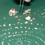 【衝撃映像】527本もの歯が生えてしまった7歳の男の子、無事抜くことに成功。