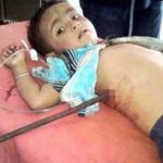 【閲覧注意】鉄の棒やハサミなどが身体に刺さってしまった人々。