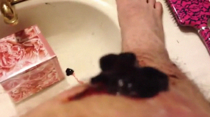 レスリングで足を負傷。その2週間後、ジェル状になった血液がニュルニュルと･･･。