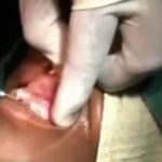 膿んでしまった歯茎から大量の膿を摘出する手術映像。