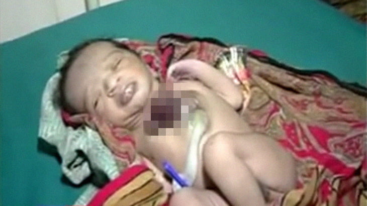 【衝撃映像】心臓が外に飛び出した状態で生まれてきてしまった赤ちゃん。