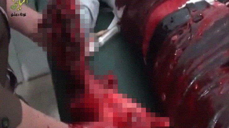 【閲覧注意】右手が吹き飛ばされてしまった男性のグロ動画。