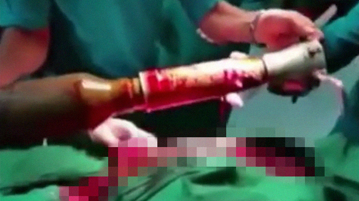 【閲覧注意】ミサイルが下半身を貫通してしまった兵士を手術するグロ動画。