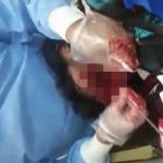 【閲覧注意】顔を爆弾で吹き飛ばされてしまった男性を手術するグロ動画。