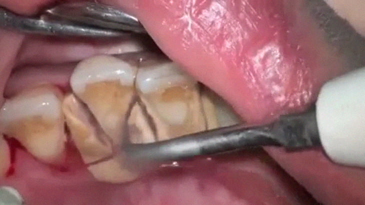 歯の裏に溜まった歯石を除去するスッキリ動画。